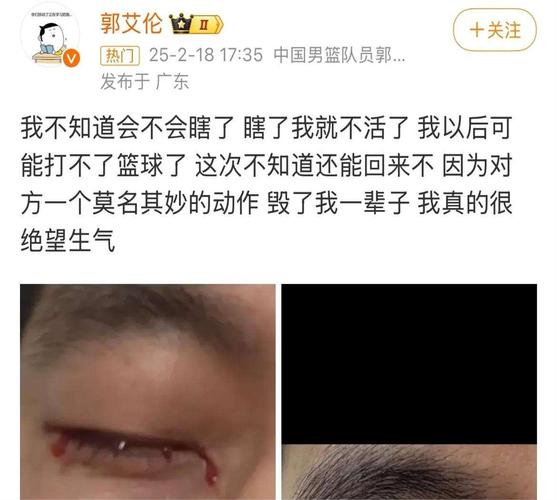 郭艾伦受伤专访：眼睛被捅瞬间绝望，怒斥对手不必要动作